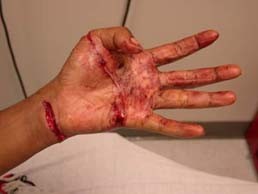 Bites from nonhuman primates can cause severe lacerations.